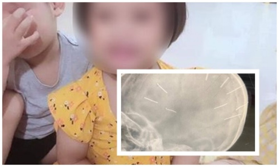 Bé gái mới 3 tuổi ở Thạch Thất, Hà Nội phải nhập viện trong tình trạng hôn mê, co giật toàn thân